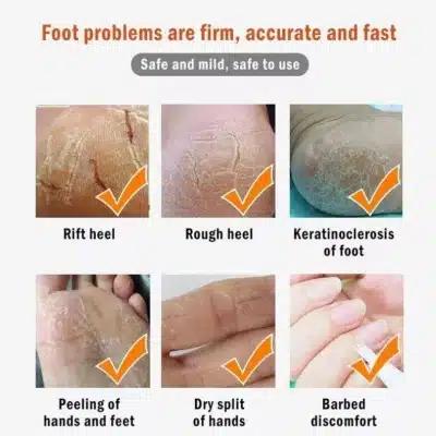 Επαναφορτιζόμενη Συσκευή Περιποίησης Πέλματος και Απομάκρυνσης Κάλων Με Απορρόφηση-Callus Remover 