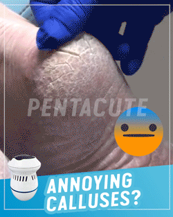 Ηλεκτρική Μηχανή Αφαίρεσης Κάλων & Νεκρών Κυττάρων-Foot Treat ΟΕΜ