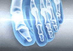 Σετ ToeRELIEF Spacer - Ευθυγραμμιστικό & Διαχωριστικό Δαχτύλων - Διορθωτής για Κότσι & Πρόληψης