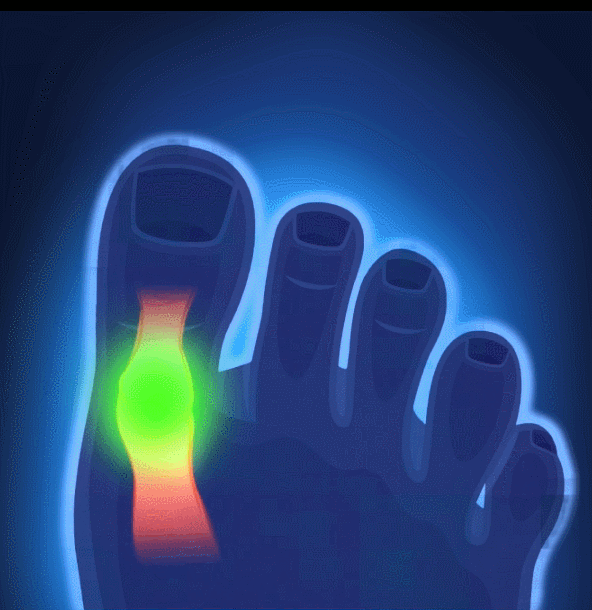 Σετ ToeRELIEF Spacer - Ευθυγραμμιστικό & Διαχωριστικό Δαχτύλων - Διορθωτής για Κότσι & Πρόληψης