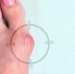 ToeRELIEF - Διαχωριστικό Δαχτύλων & Διορθωτής για Κότσι Σιλικόνης