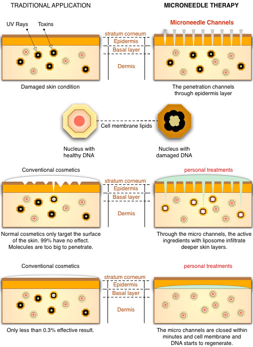derma roller needle roller botox facelift dermaroller