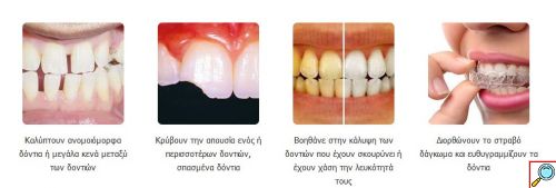 Snap On Smile - Μασελάκι Μεταμόρφωσης Χαμόγελου - Αφαιρούμενη Οδοντική Όψη Ρητίνης για Άνω ή Κάτω Γνάθο