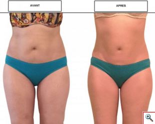 Κολάν - Κορσές Lastex για Εφίδρωση, Σύσφιξη και Αδυνάτισμα - Fiber Slim Lift Panty Cryotherapy