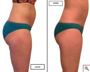 Κολάν - Κορσές Lastex για Εφίδρωση, Σύσφιξη και Αδυνάτισμα - Fiber Slim Lift Panty Cryotherapy