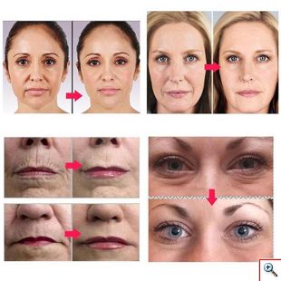 Συσκευή Μασάζ Προσώπου 4 σε 1 - Needle Roller Σύστημα με Μικροακίδες