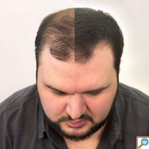 VolumON Hair Building Fibers, Μικρο-ίνες Φυσικής Κερατίνης κατά της Τριχόπτωσης & Αραίωσης των Μαλλιών 12γρ