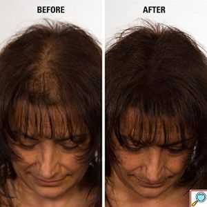 VolumON Hair Building Fibers, Μικρο-ίνες Φυσικής Κερατίνης κατά της Τριχόπτωσης & Αραίωσης των Μαλλιών 12γρ