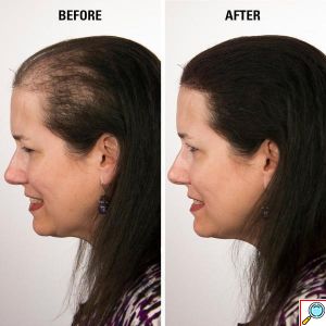 VolumON Hair Building Fibers, Μικρο-ίνες Φυσικής Κερατίνης κατά της Τριχόπτωσης & Αραίωσης των Μαλλιών 12γρ