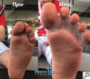 Σετ ToeRELIEF Spacer - Ευθυγραμμιστικό & Διαχωριστικό Δαχτύλων - Διορθωτής για Κότσι & Πρόληψης