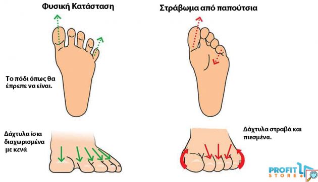 Σετ ToeRELIEF Spacer - Ευθυγραμμιστικό & Διαχωριστικό Δαχτύλων - Διορθωτής για Κότσι & Πρόληψης