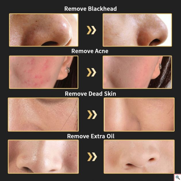 Blackhead SpotCleaner Professional XD5002 για τον Καθαρισμό του Προσώπου από τα Μαύρα Στίγματα