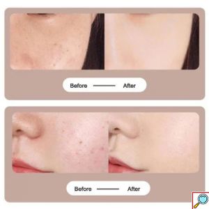 Στυλό λέιζερ αφαίρεσης ελιών και θεραπεία του δέρματος κατά της ακμής Mole Removal Pen