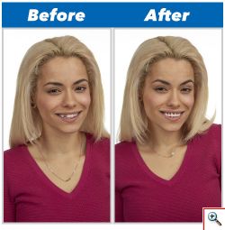 Μασελάκι Perfect Smile για όμορφα δόντια και υπέροχο χαμόγελο, τεχνητή οδοντοστοιχία, εμφυτεύματα δοντιών, ορθοδοντική, σιδεράκια, μασελάκια, στραβά δόντια, θήκες, ναρθηκες δοντιών, ψεύτικα δόντια
