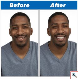 Μασελάκι Perfect Smile για όμορφα δόντια και υπέροχο χαμόγελο, τεχνητή οδοντοστοιχία, εμφυτεύματα δοντιών, ορθοδοντική, σιδεράκια, μασελάκια, στραβά δόντια, θήκες, ναρθηκες δοντιών, ψεύτικα δόντια