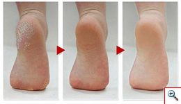 Επαναφορτιζόμενη Συσκευή Αφαίρεσης Κάλων Πλενόμενη SmoothFeet