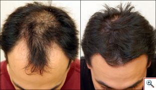 Χτένα Ενίσχυσης της Τριχοφυΐας με Laser και Δόνηση - Power Grow Comb 