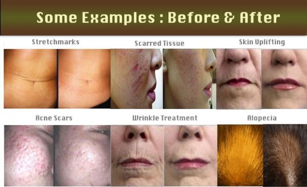 Micro NeedleRoller - Επαγγελματική μέθοδος Ανανέωσης & Αντιγήρανσης