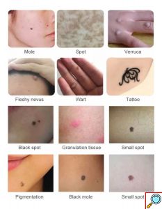 Ψηφιακό Plasma Pen για Σπίλους, Κηλίδες & Τατουάζ - 9 Επίπεδα Ισχύος με LCD Οθόνη & Φωτισμό