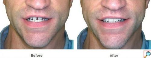 Snap On Smile - Μασελάκι Μεταμόρφωσης Χαμόγελου - Αφαιρούμενη Οδοντική Όψη Ρητίνης για Άνω ή Κάτω Γνάθο